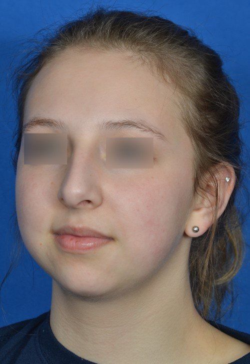 rhinoplasty