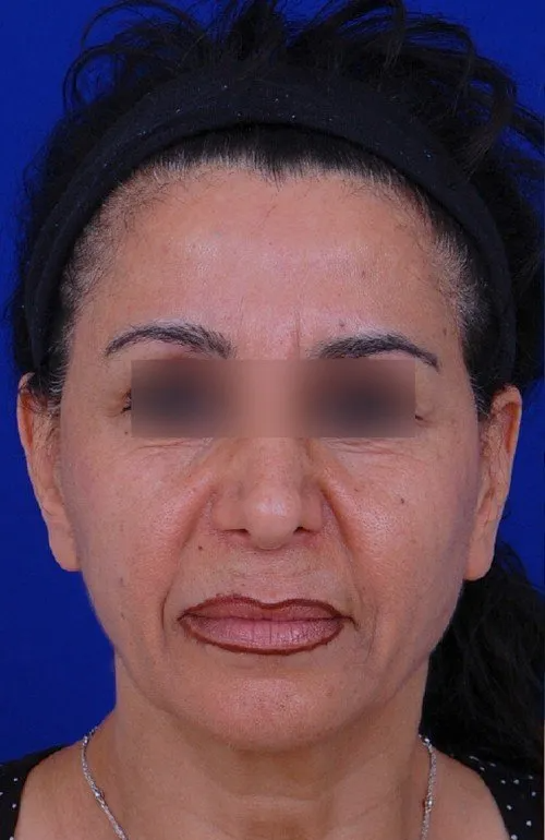 female facelift