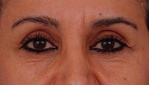 blepharoplasty before and after