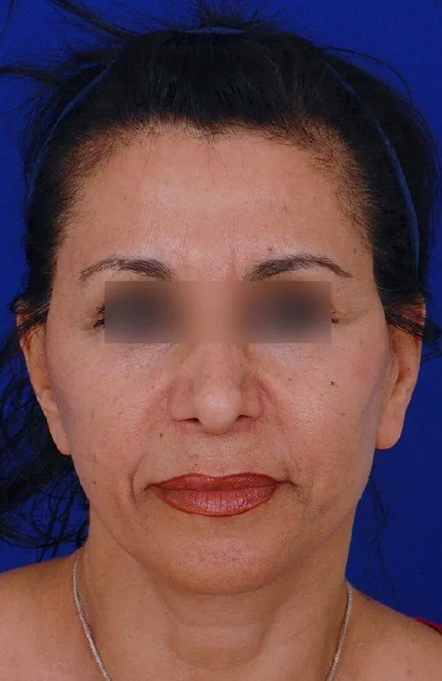 female facelift