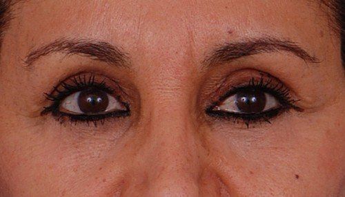 blepharoplasty before and after