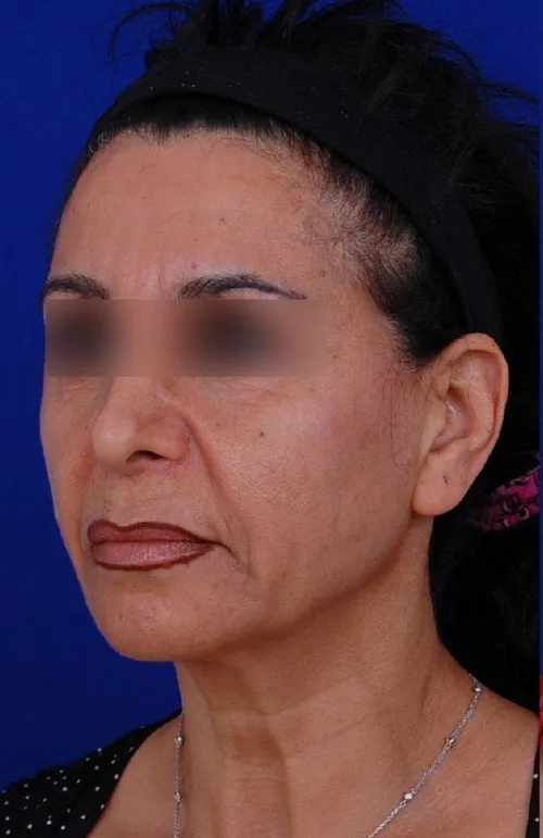 female facelift