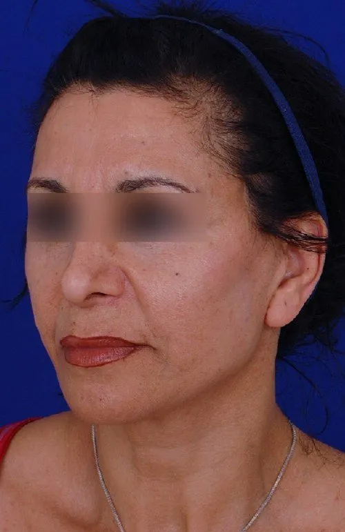 female facelift