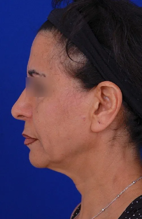 female facelift