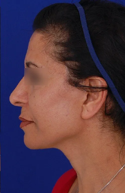 female facelift