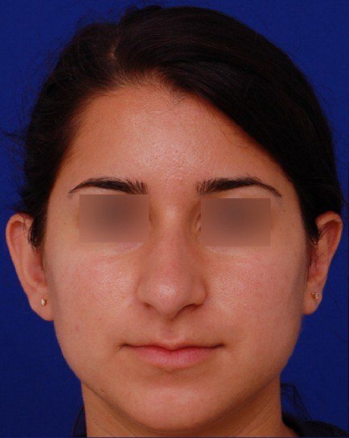 rhinoplasty