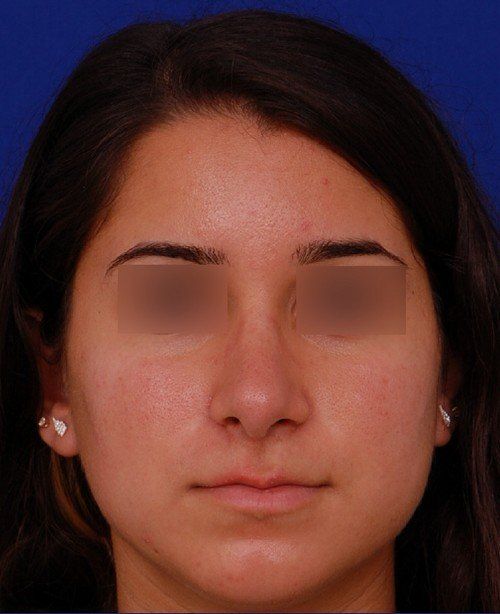 rhinoplasty