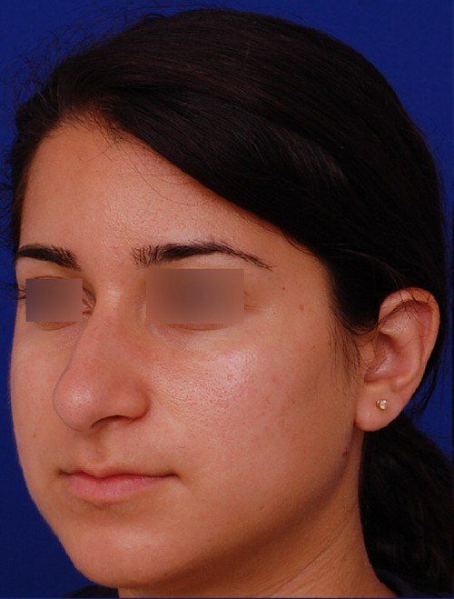 rhinoplasty