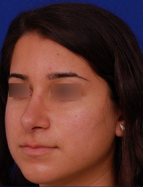 rhinoplasty