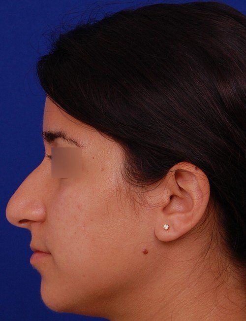 rhinoplasty