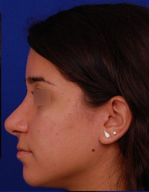 rhinoplasty