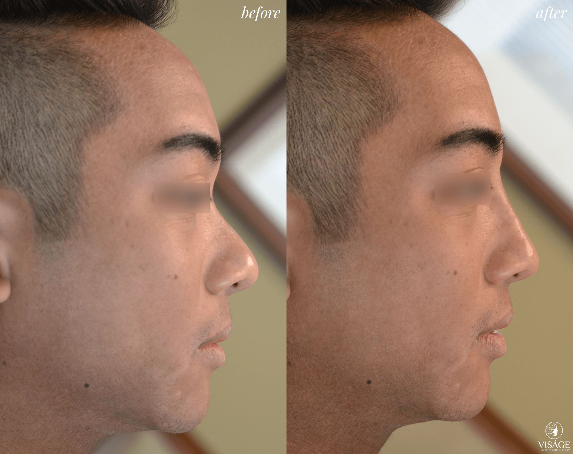 before and after nonsurgical rhinplasty