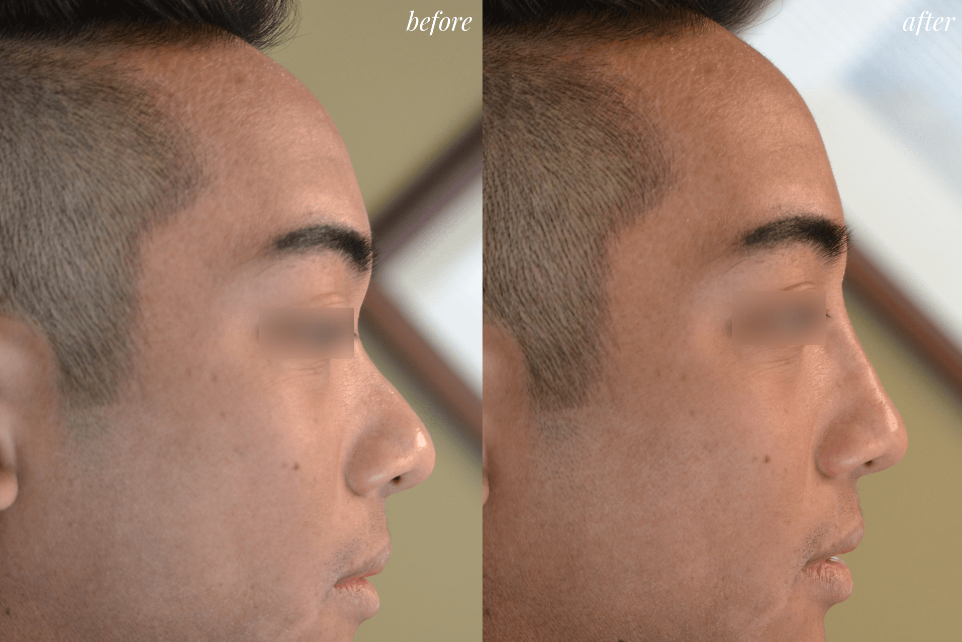 rhinoplasty before and after