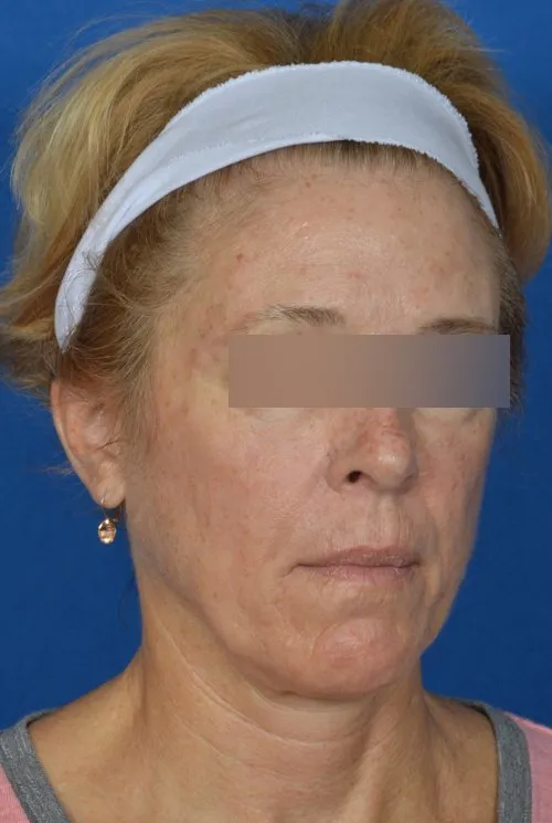 mini facelift before and after