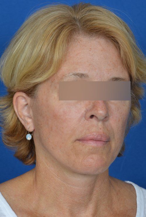 mini facelift before and after