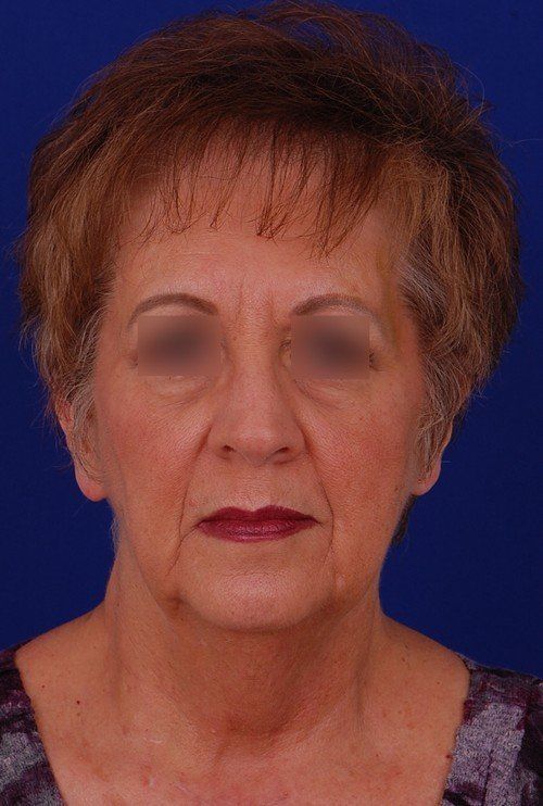 woman before facelift