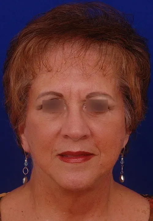female facelift