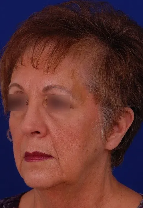 woman before facelift