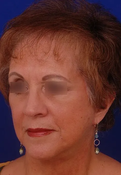 female facelift
