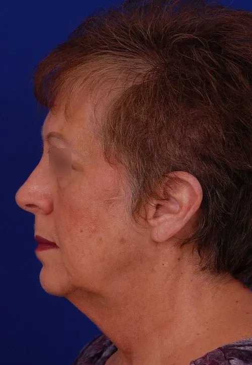 woman before facelift