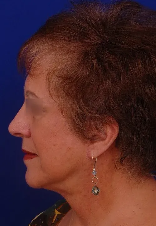 woman after facelift