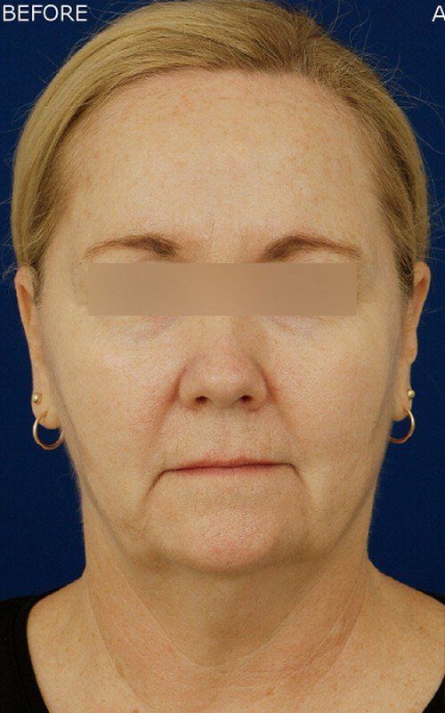 female facelift