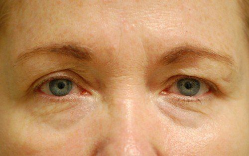 woman before upper and lower blepharoplasty