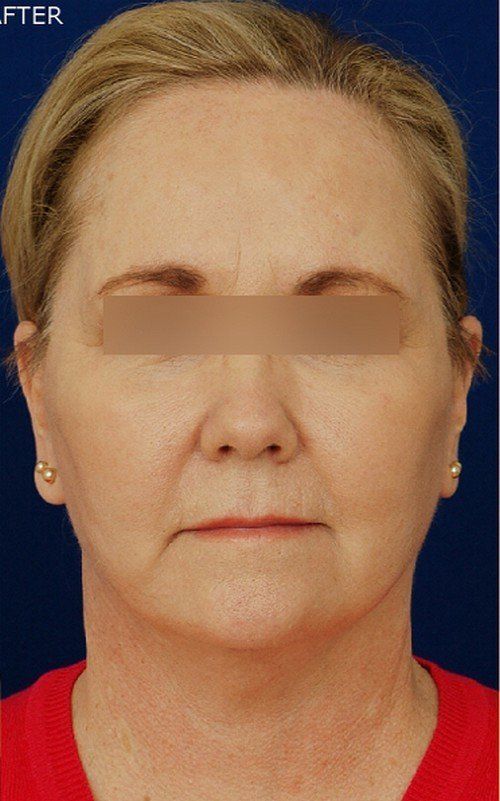 female facelift