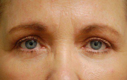woman after upper and lower blepharoplasty