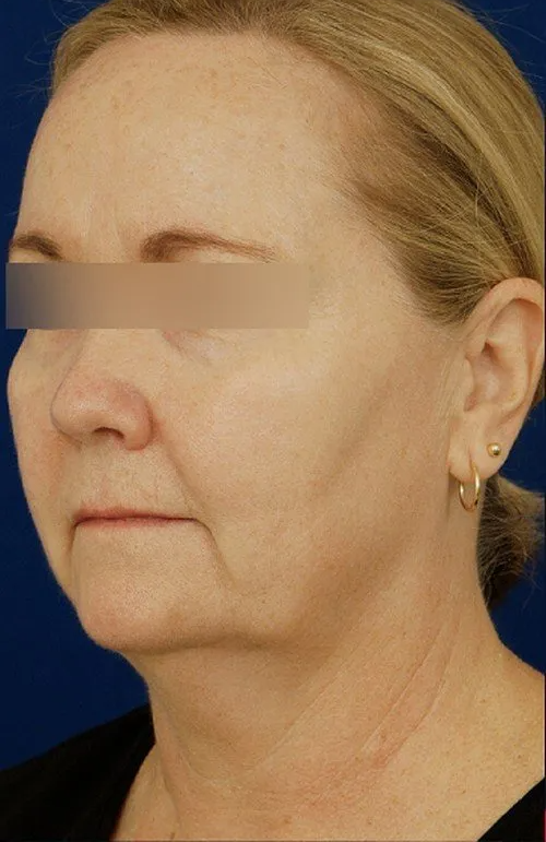 female facelift