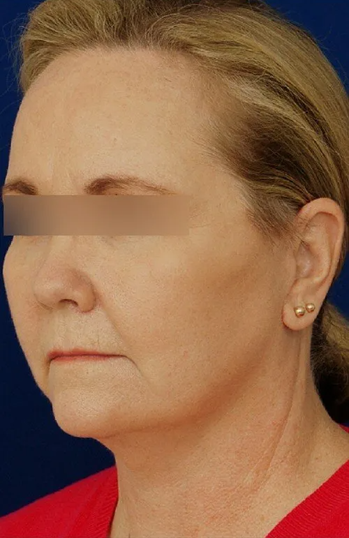 female facelift