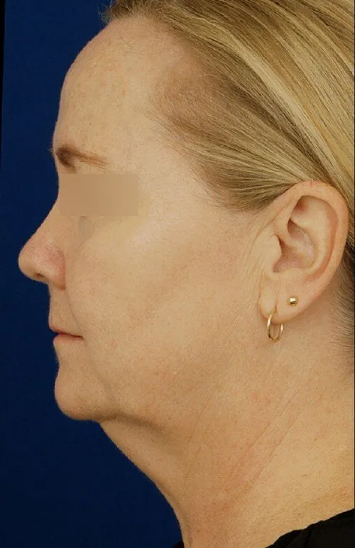 female facelift