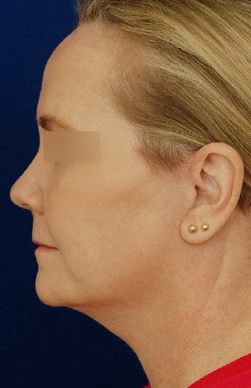 female facelift