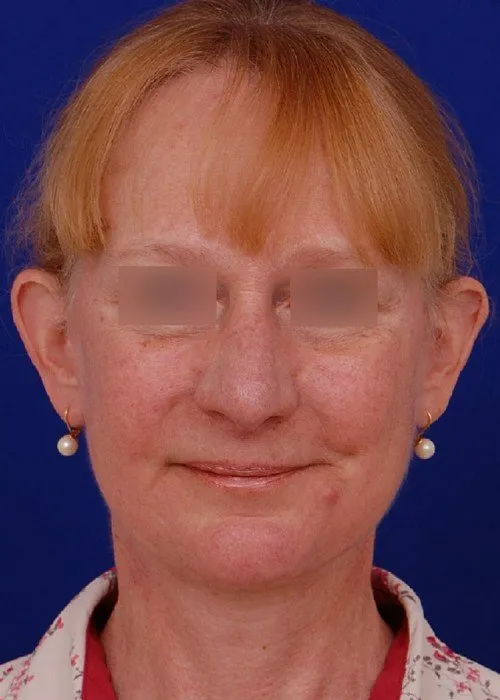 female facelift