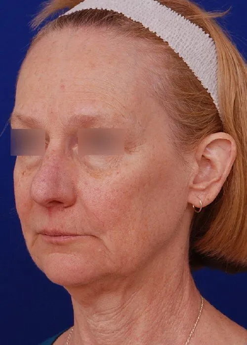 female facelift