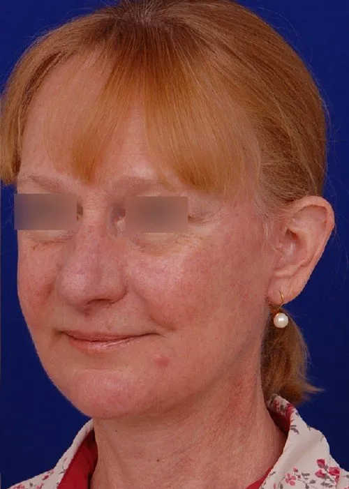 female facelift