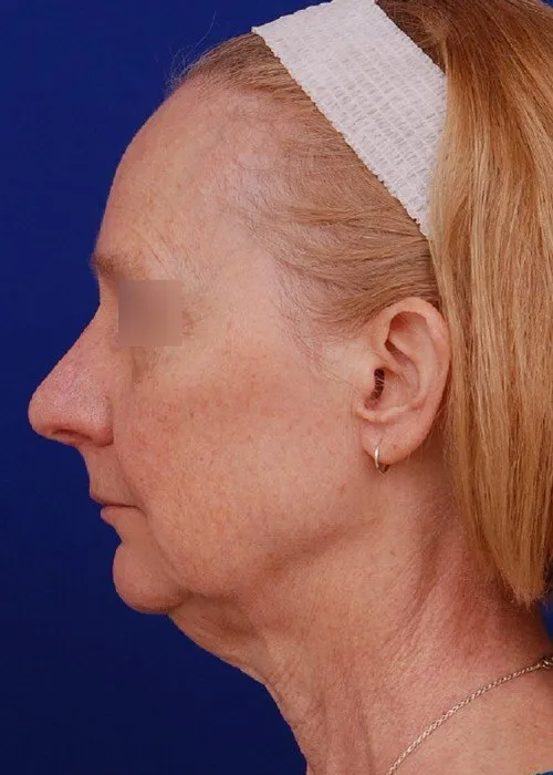 woman before facelift