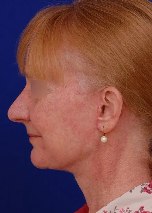 female facelift