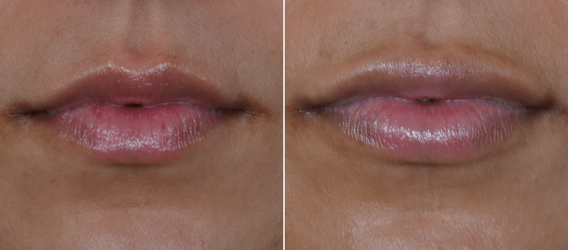 before and after permalip implants