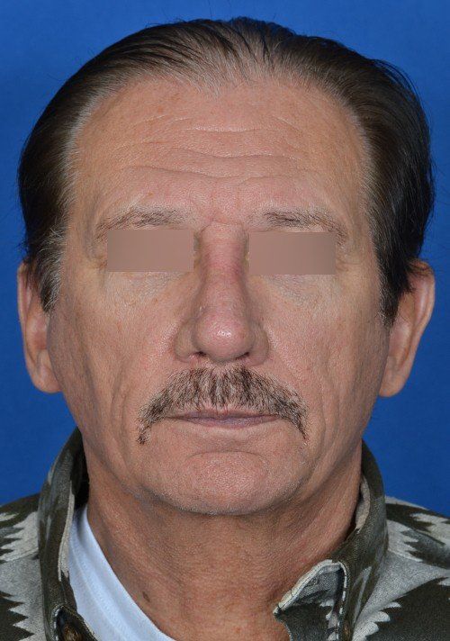 male revision rhinoplasty