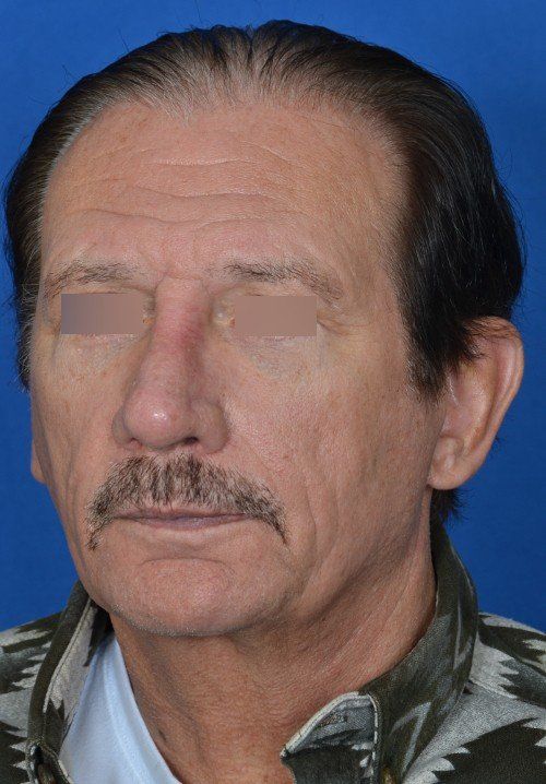 revision revision rhinoplastyrhinoplasty