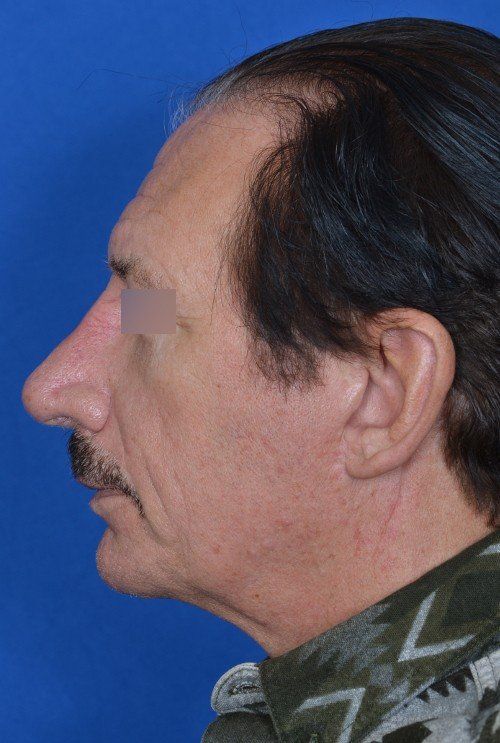 revision rhinoplasty