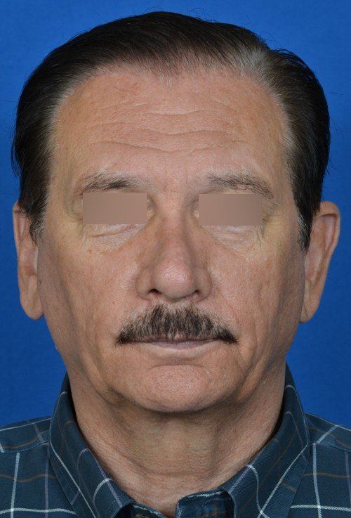 revision rhinoplasty