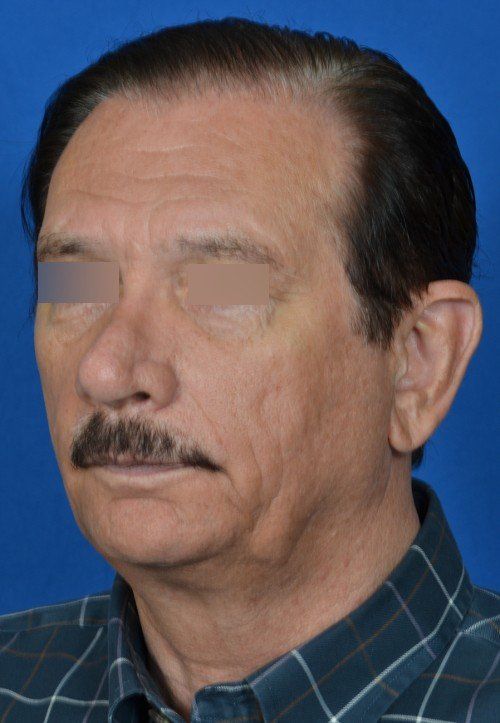 revision rhinoplasty