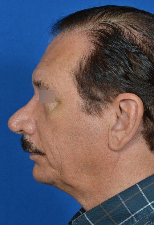 revision rhinoplasty
