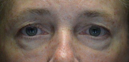 blepharoplasty before and after