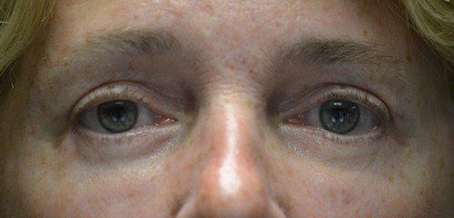 blepharoplasty before and after
