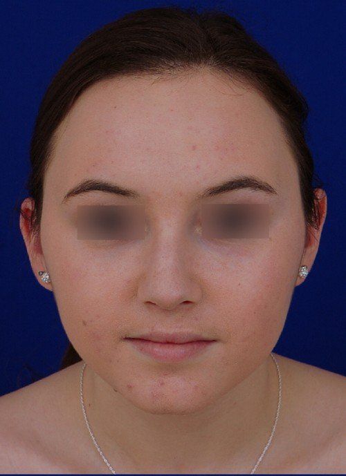 female rhinoplasty