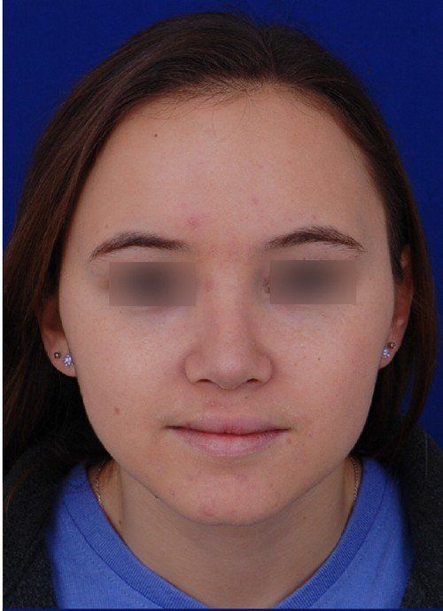 female rhinoplasty