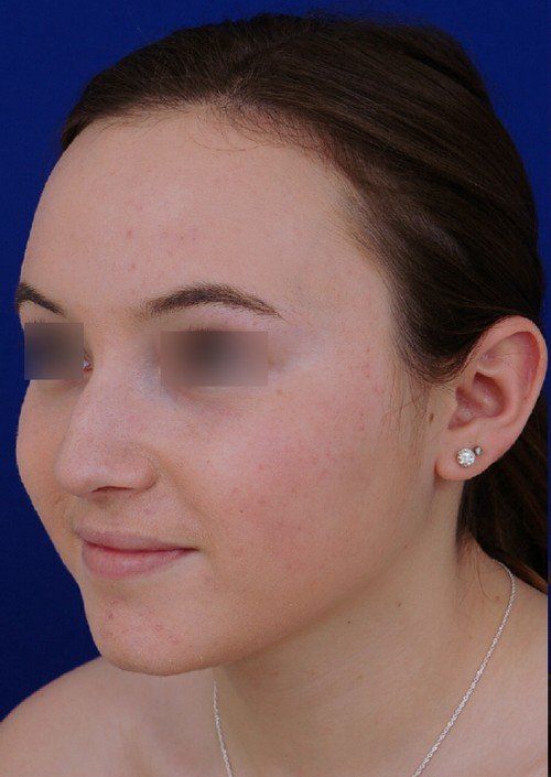 female rhinoplasty